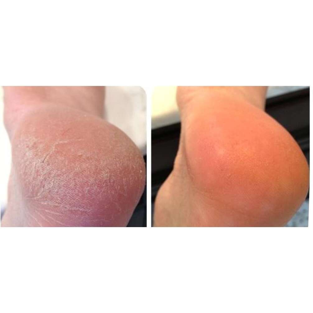 CREAM TUMIT PECAH KAKI PECAH THERASKIN AHA FOOT GEL MENGHALUSKAN DAN MENGHILANGKAN TUMIT RETAK 3 CREAM TUMIT PECAH KAKI PECAH THERASKIN AHA FOOT GEL MENGHALUSKAN DAN MENGHILANGKAN TUMIT RETAK - Image 3