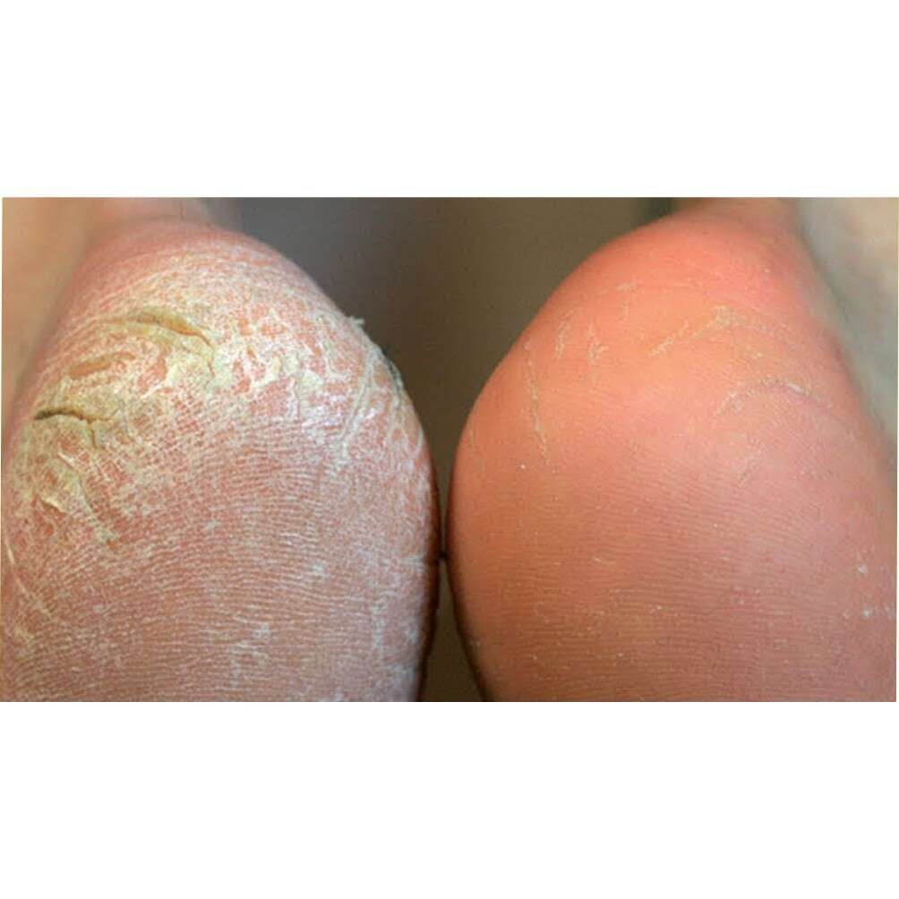 CREAM TUMIT PECAH KAKI PECAH THERASKIN AHA FOOT GEL MENGHALUSKAN DAN MENGHILANGKAN TUMIT RETAK 2 CREAM TUMIT PECAH KAKI PECAH THERASKIN AHA FOOT GEL MENGHALUSKAN DAN MENGHILANGKAN TUMIT RETAK - Image 2