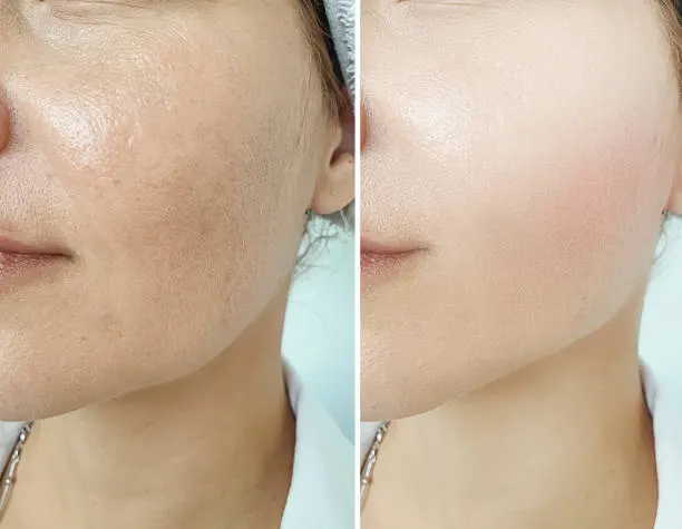 before after
