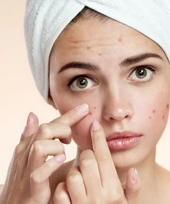 sunscreen acne dr andini