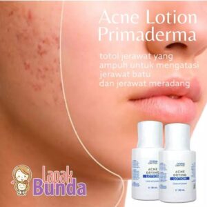Obat Totol Jerawat